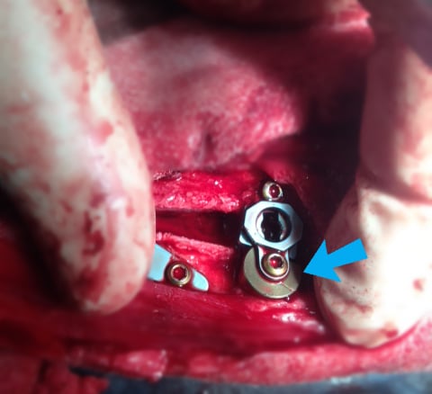 spacer for correcting patella luxation
