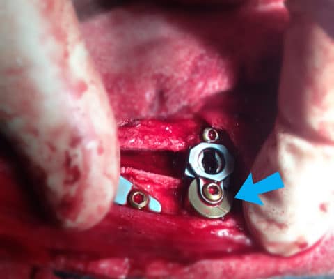 Surgical Correction of Cruciate Tear and Patella Luxation in Dog